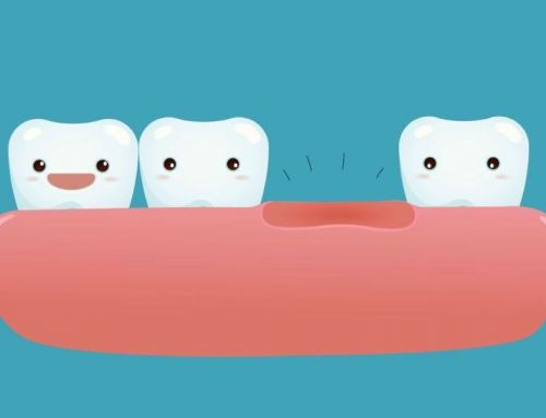 Perdere un dente: conseguenze e possibili soluzioni
