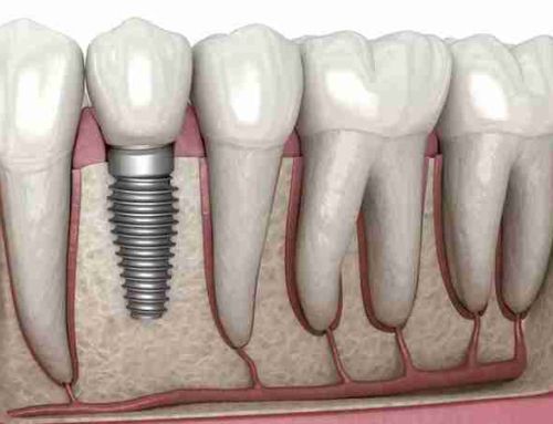 Impianti dentali: tutte le domande da sapere
