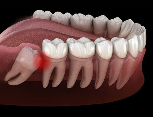 Quando togliere i denti del giudizio